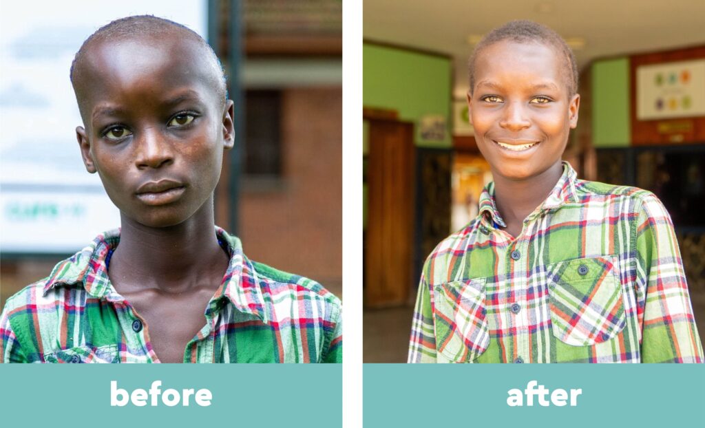 Isaac before and after life-saving surgery at CURE Uganda.